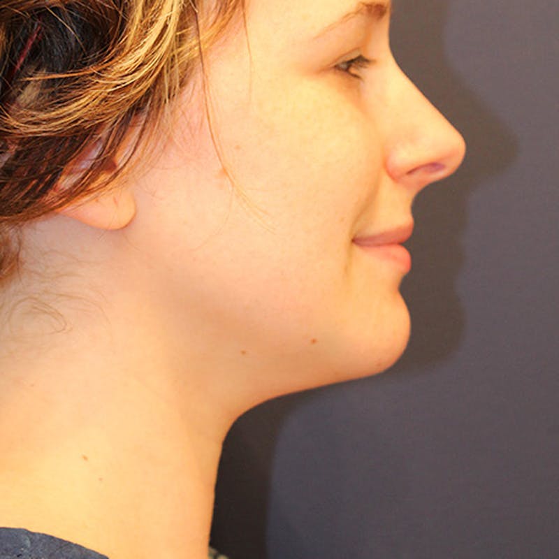 Neck Liposuction Before & After Gallery - Patient 174146483 - Image 6
