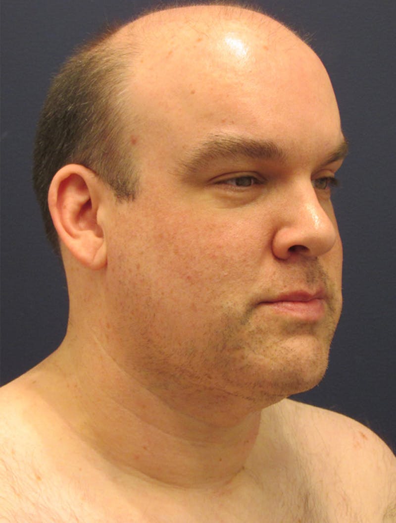 Neck Liposuction Before & After Gallery - Patient 174146489 - Image 3