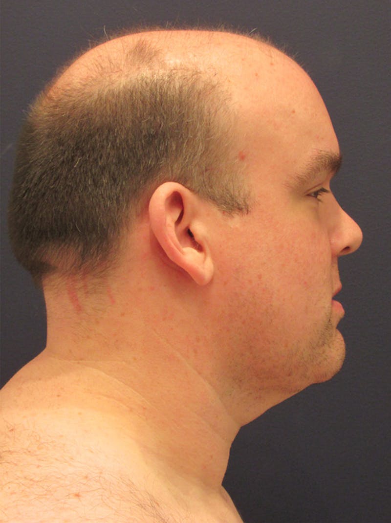 Neck Liposuction Before & After Gallery - Patient 174146489 - Image 5