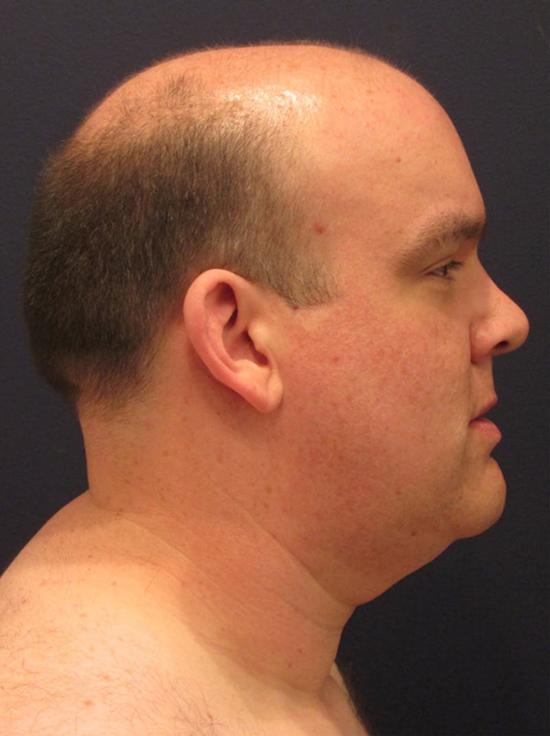 Neck Liposuction Before & After Gallery - Patient 174146489 - Image 6