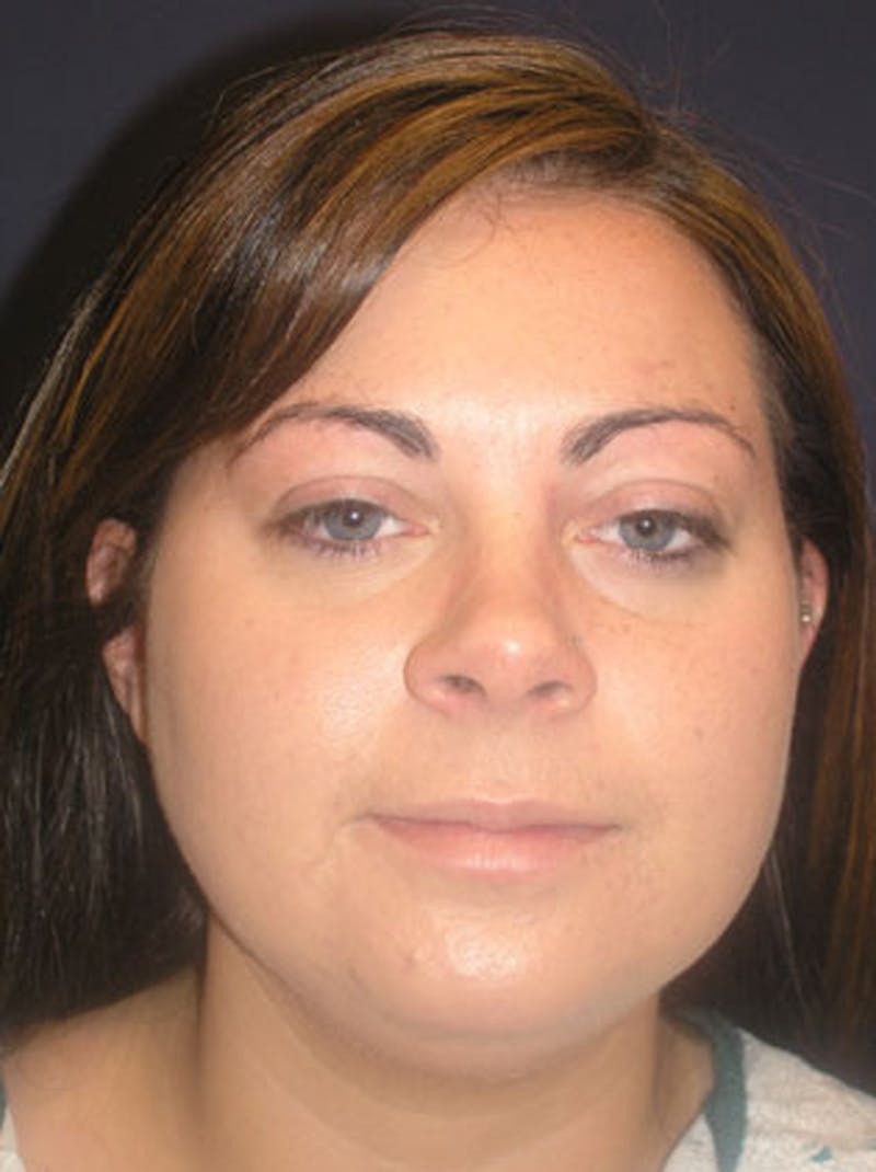 Neck Liposuction Before & After Gallery - Patient 174146491 - Image 1