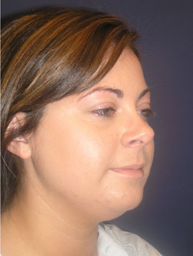 Neck Liposuction Before & After Gallery - Patient 174146491 - Image 3