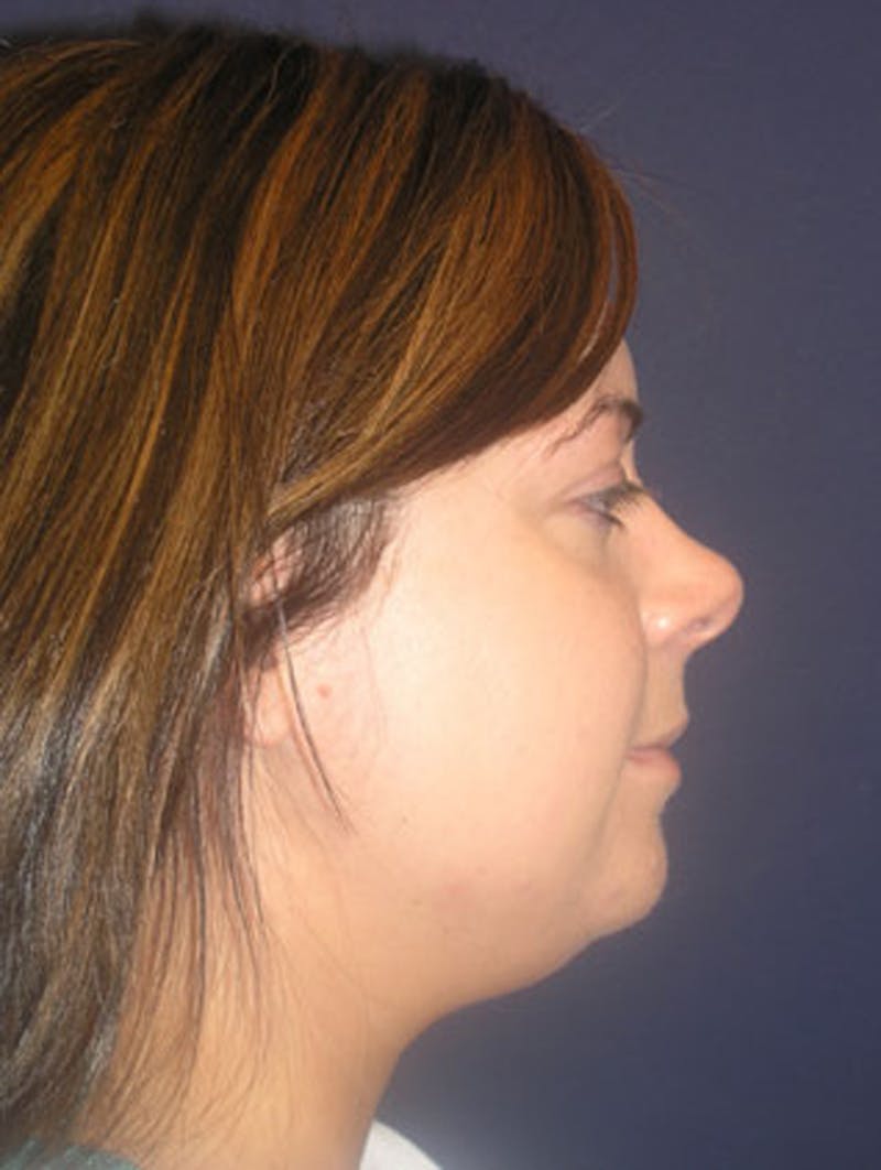 Neck Liposuction Before & After Gallery - Patient 174146491 - Image 5
