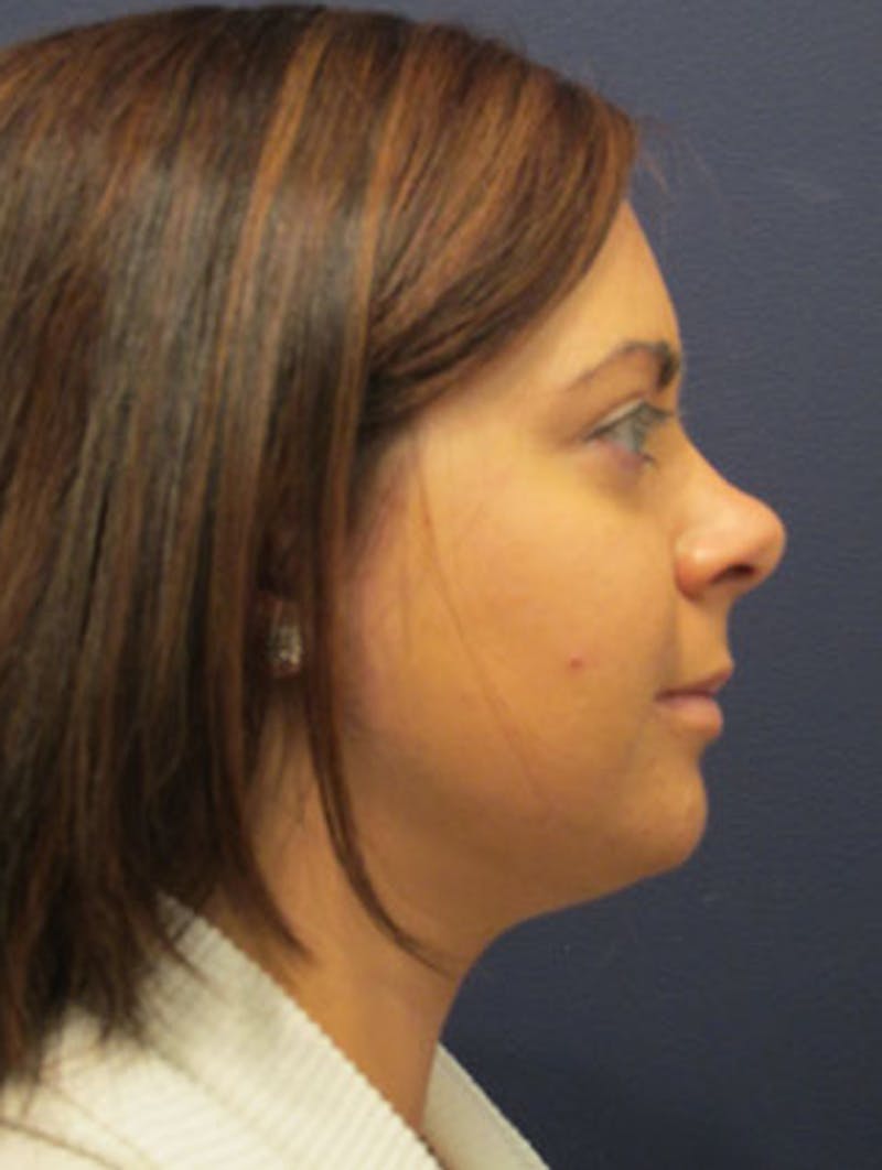 Neck Liposuction Before & After Gallery - Patient 174146491 - Image 6