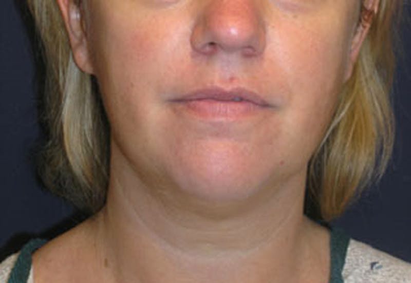 Neck Liposuction Before & After Gallery - Patient 174146496 - Image 1