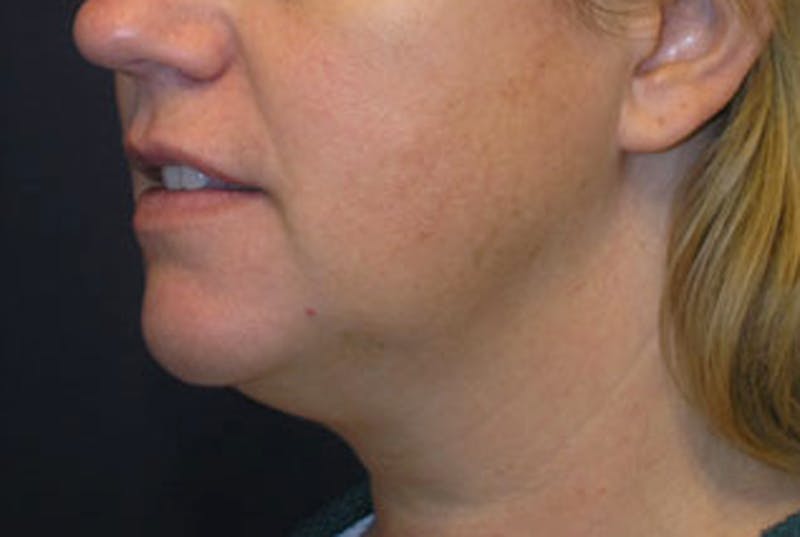 Neck Liposuction Before & After Gallery - Patient 174146496 - Image 3