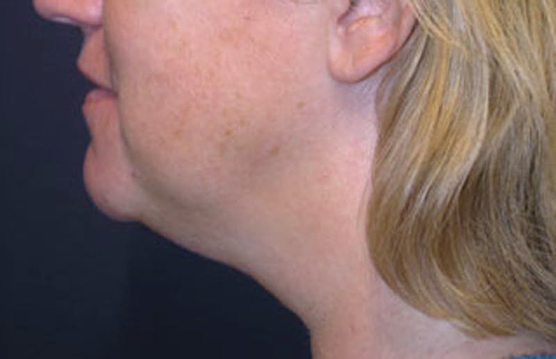 Neck Liposuction Before & After Gallery - Patient 174146496 - Image 5