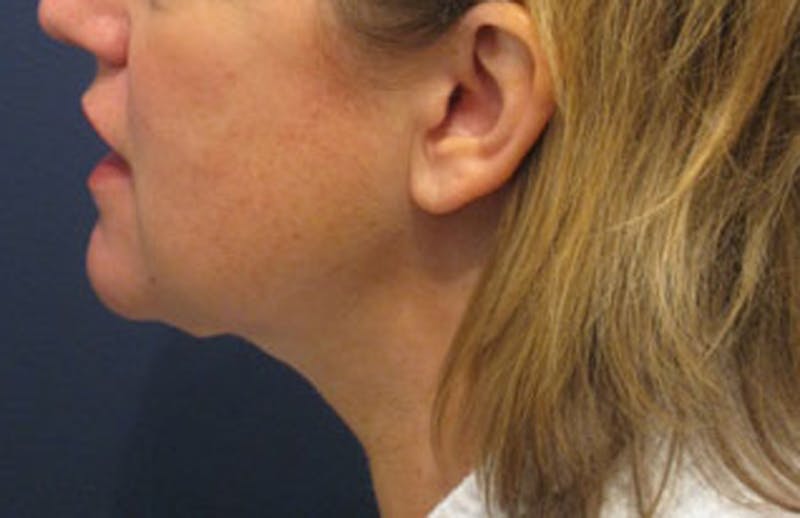 Neck Liposuction Before & After Gallery - Patient 174146496 - Image 6