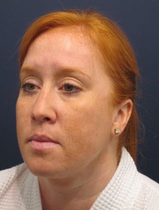 Neck Liposuction Before & After Gallery - Patient 174146500 - Image 4