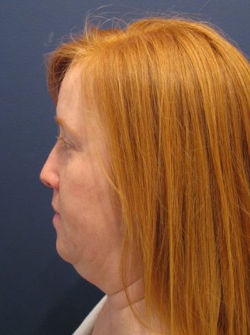 Neck Liposuction Before & After Gallery - Patient 174146500 - Image 5