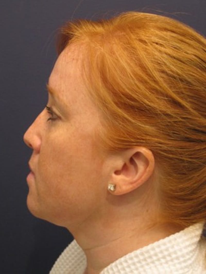 Neck Liposuction Before & After Gallery - Patient 174146500 - Image 6