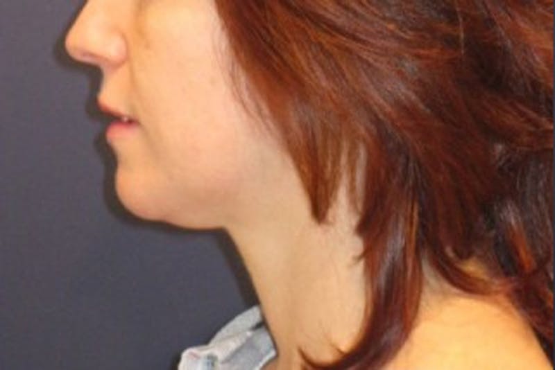 Neck Liposuction Before & After Gallery - Patient 174146504 - Image 1