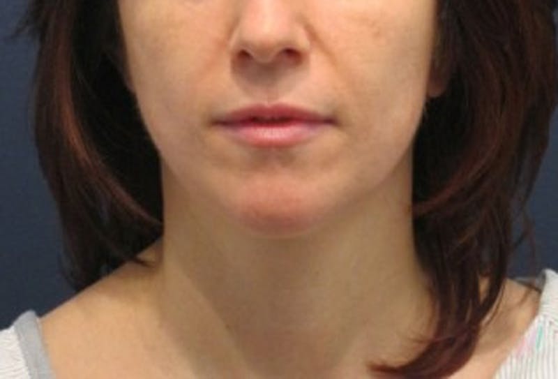 Neck Liposuction Before & After Gallery - Patient 174146504 - Image 3