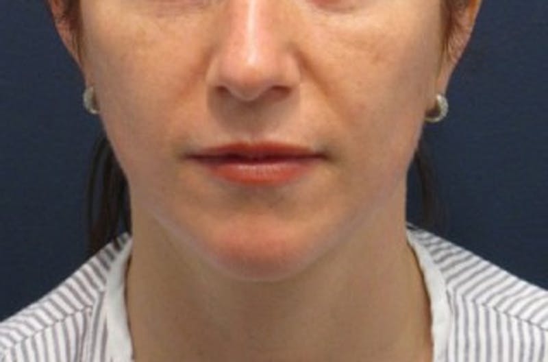 Neck Liposuction Before & After Gallery - Patient 174146504 - Image 4