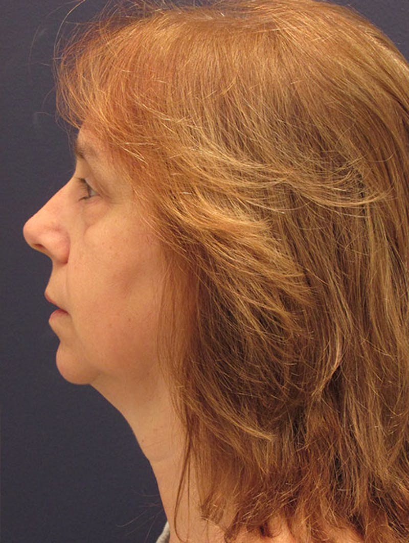 Neck Liposuction Before & After Gallery - Patient 174146507 - Image 5