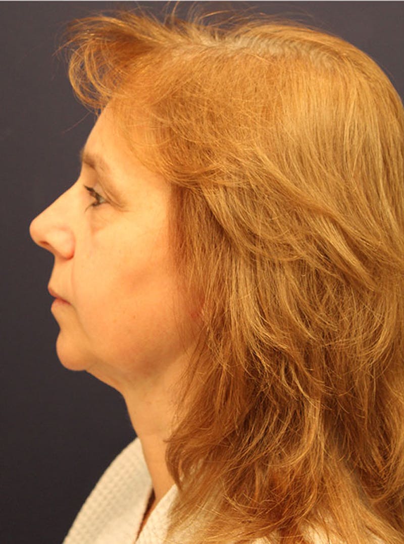 Neck Liposuction Before & After Gallery - Patient 174146507 - Image 6