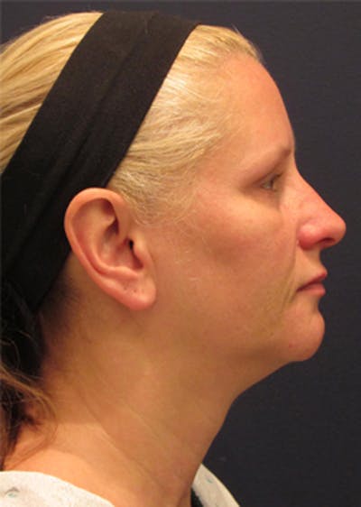 Neck Liposuction Before & After Gallery - Patient 174146511 - Image 1