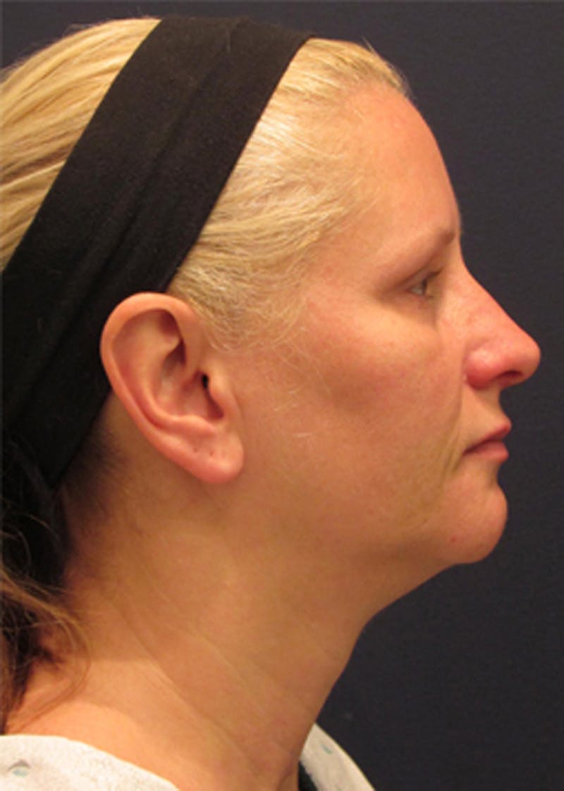 Neck Liposuction Before & After Gallery - Patient 174146511 - Image 1