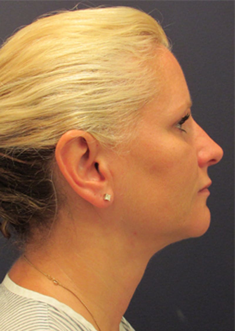 Neck Liposuction Before & After Gallery - Patient 174146511 - Image 2