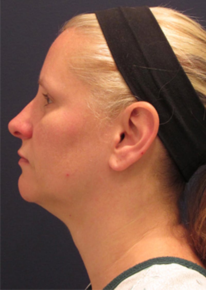 Neck Liposuction Before & After Gallery - Patient 174146511 - Image 3
