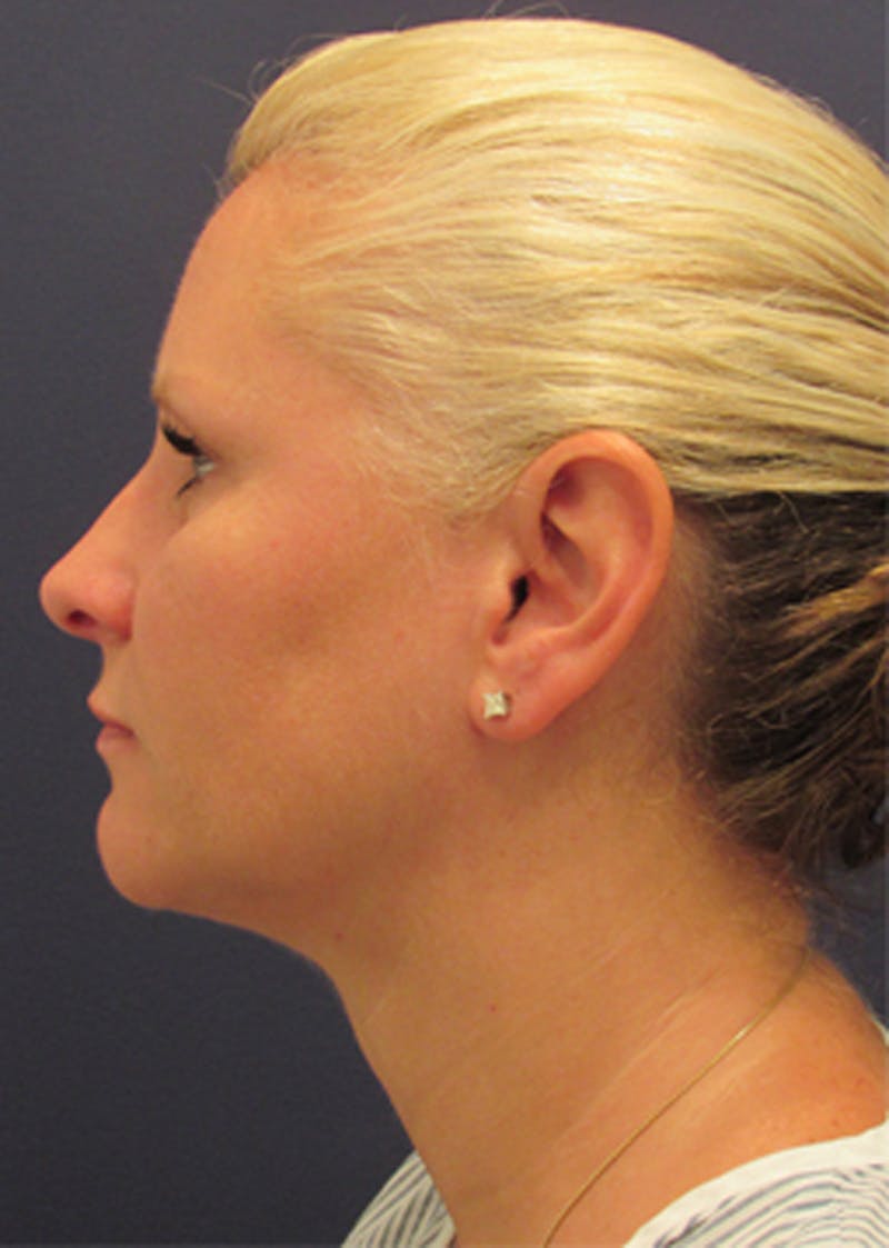 Neck Liposuction Before & After Gallery - Patient 174146511 - Image 4