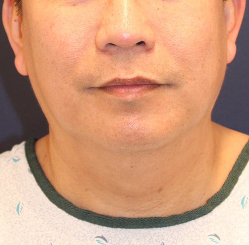 Neck Liposuction Before & After Gallery - Patient 174146520 - Image 1