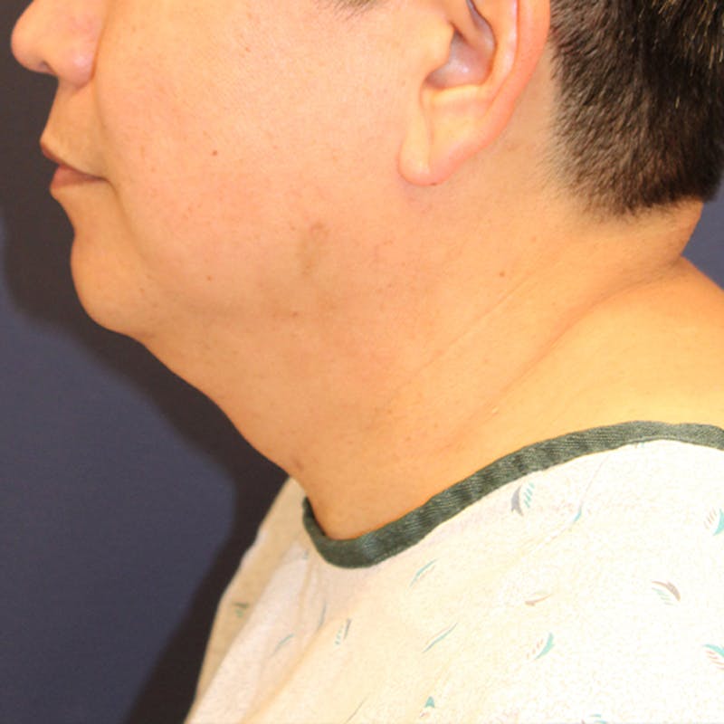 Neck Liposuction Before & After Gallery - Patient 174146520 - Image 5