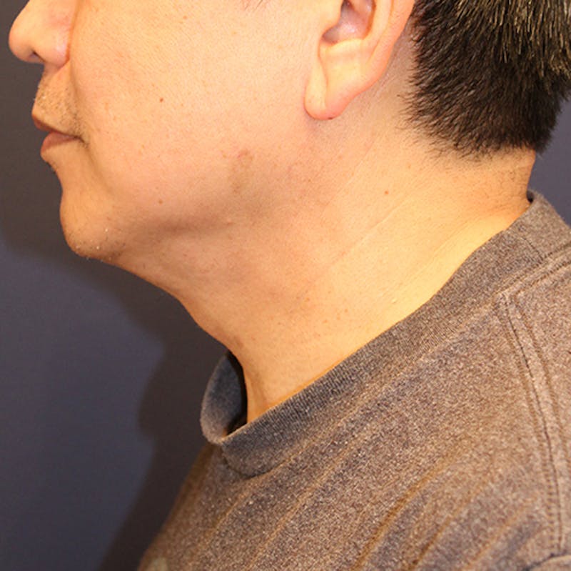 Neck Liposuction Before & After Gallery - Patient 174146520 - Image 6