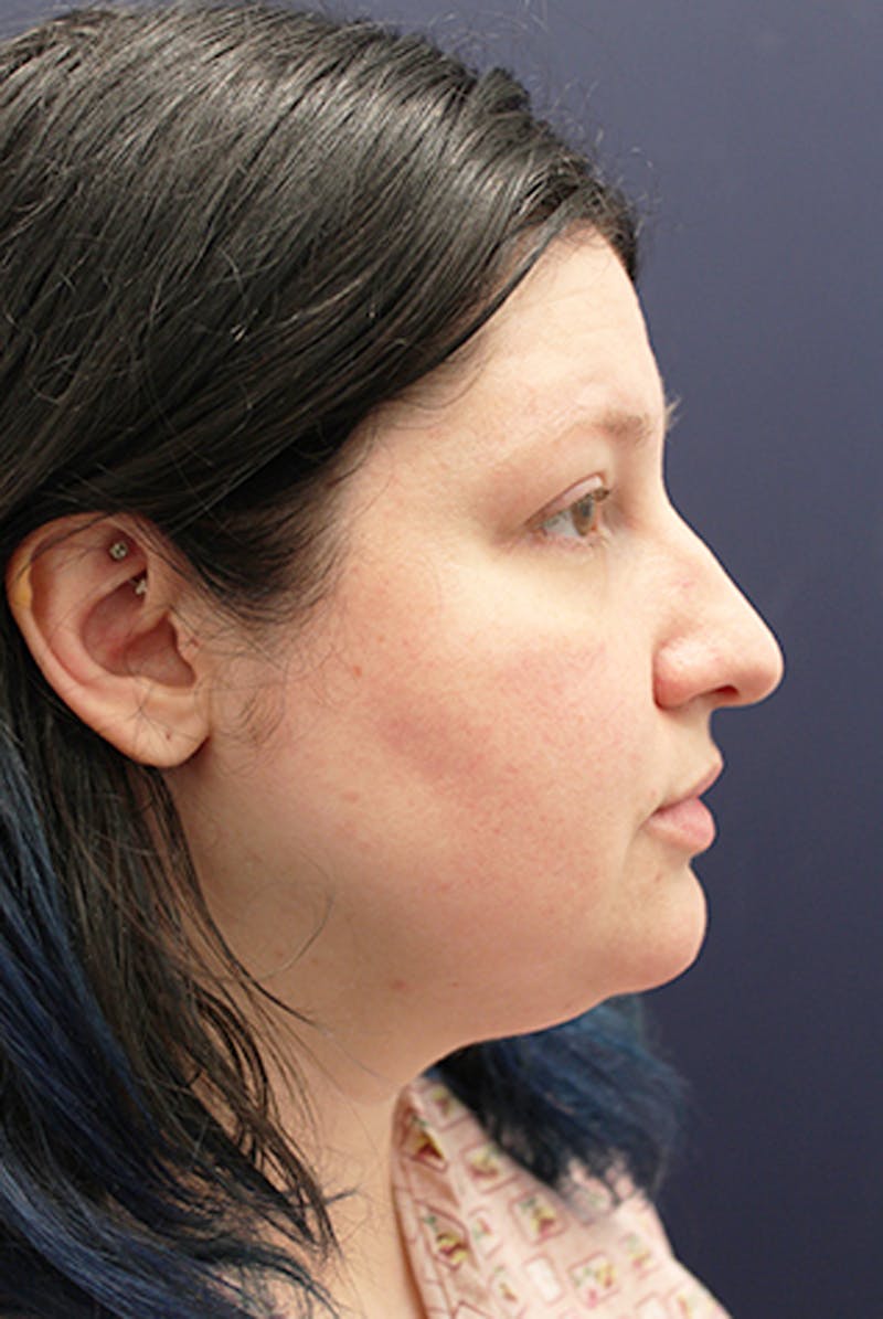 Neck Liposuction Before & After Gallery - Patient 174146525 - Image 3