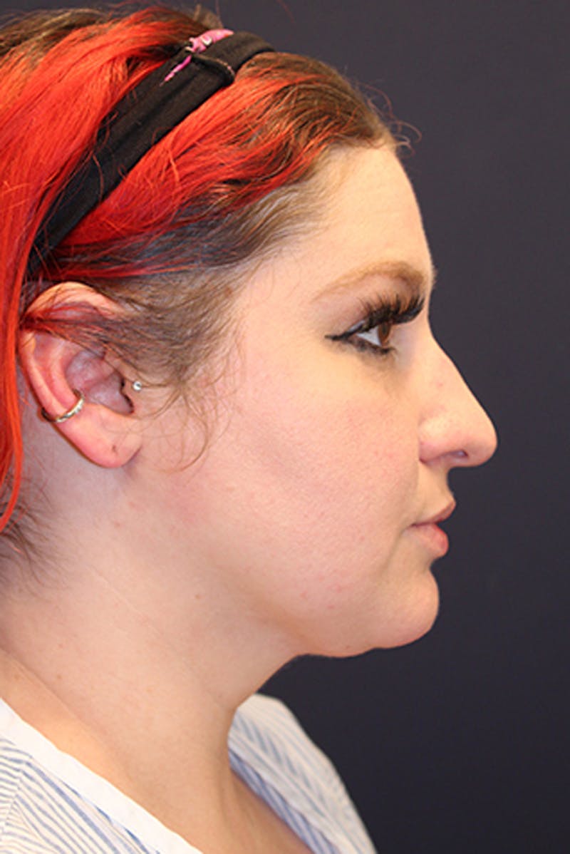 Neck Liposuction Before & After Gallery - Patient 174146525 - Image 4