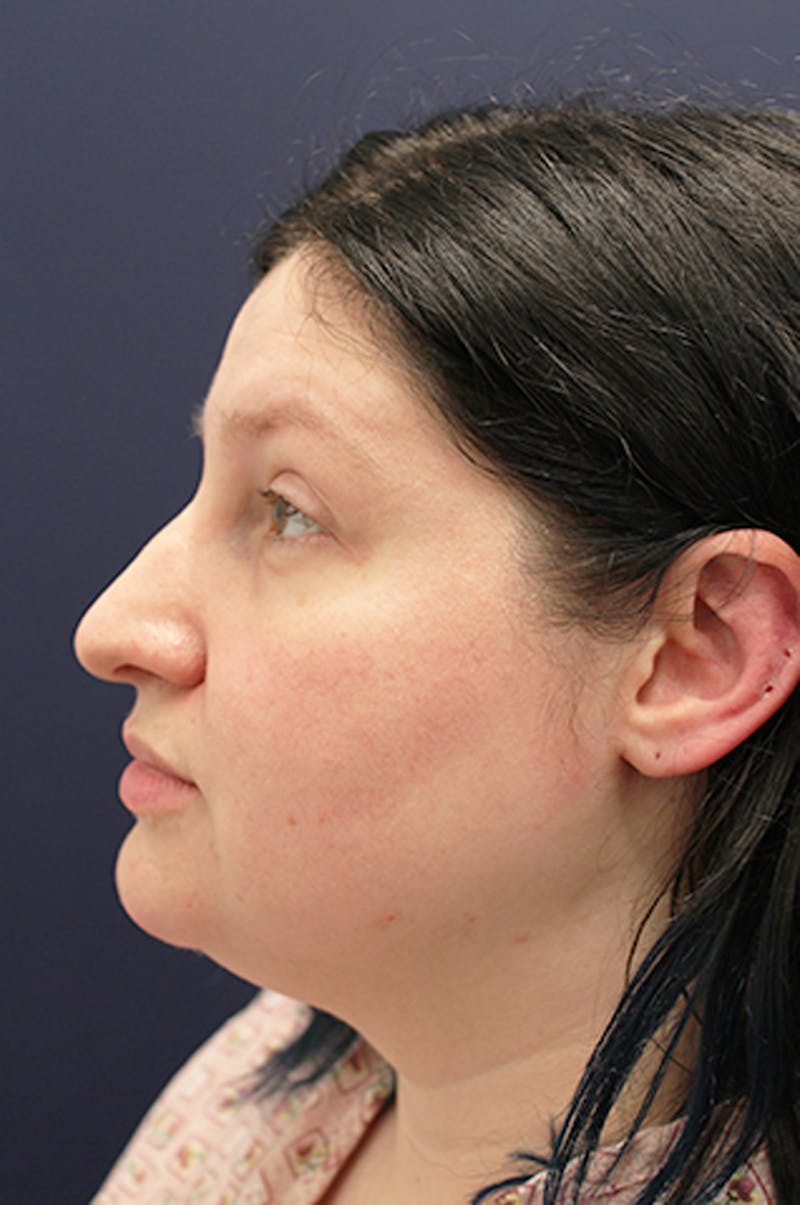 Neck Liposuction Before & After Gallery - Patient 174146525 - Image 5