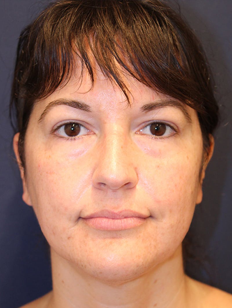 Neck Liposuction Before & After Gallery - Patient 174146532 - Image 2