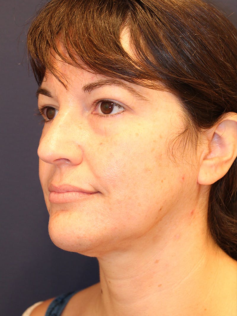Neck Liposuction Before & After Gallery - Patient 174146532 - Image 4
