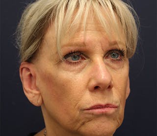 Otoplasty Before & After Gallery - Patient 174146498 - Image 4