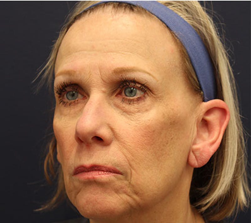 Otoplasty Before & After Gallery - Patient 174146498 - Image 5