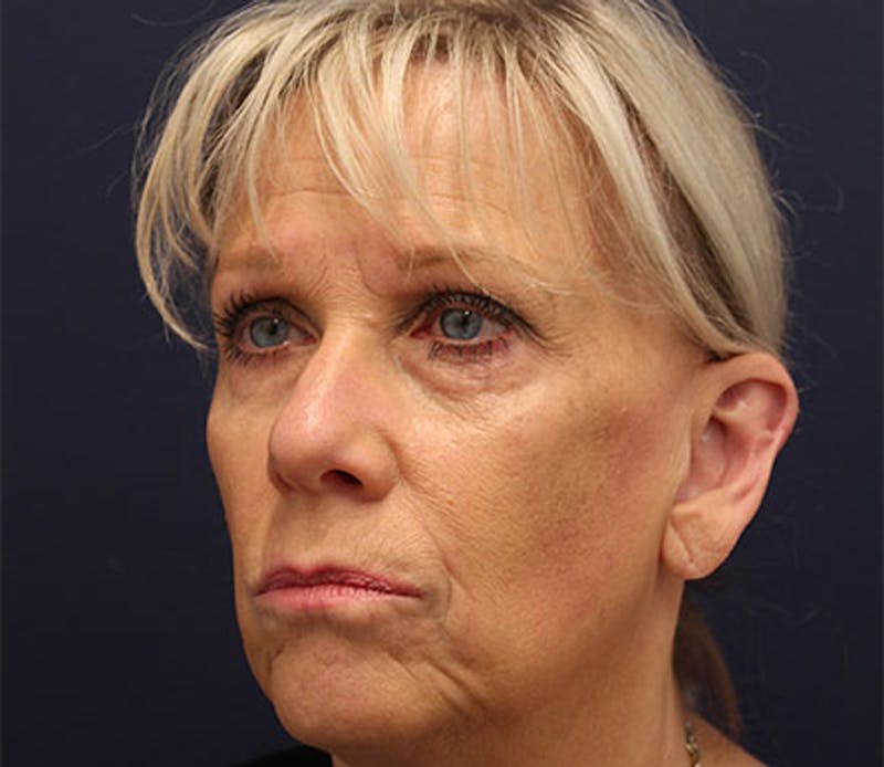 Otoplasty Before & After Gallery - Patient 174146498 - Image 6