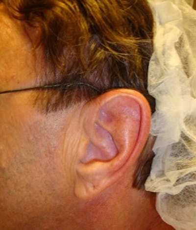 Otoplasty Before & After Gallery - Patient 174146502 - Image 1