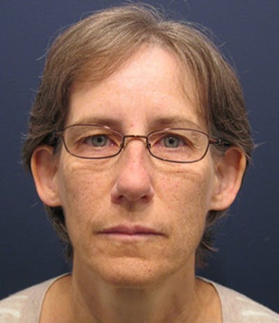 Otoplasty Before & After Gallery - Patient 174146505 - Image 1