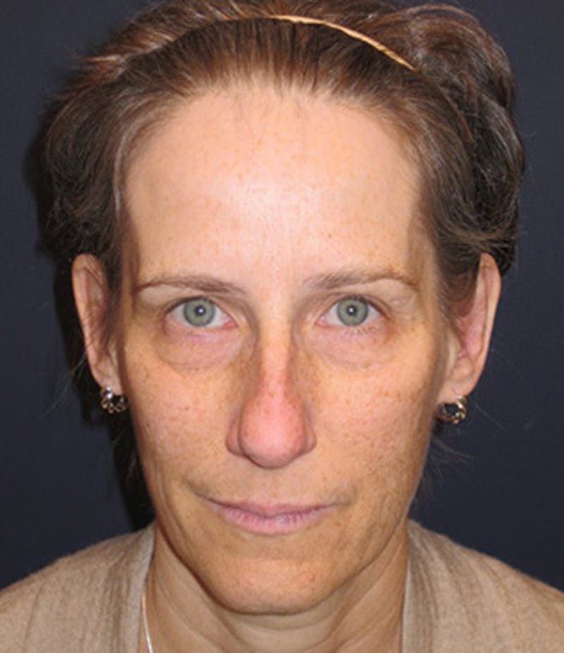 Otoplasty Before & After Gallery - Patient 174146505 - Image 2
