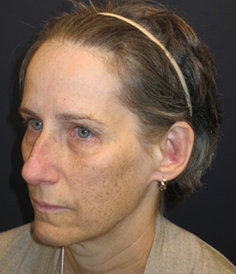 Otoplasty Before & After Gallery - Patient 174146505 - Image 4