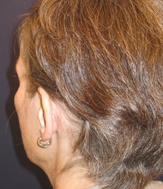 Otoplasty Before & After Gallery - Patient 174146505 - Image 6