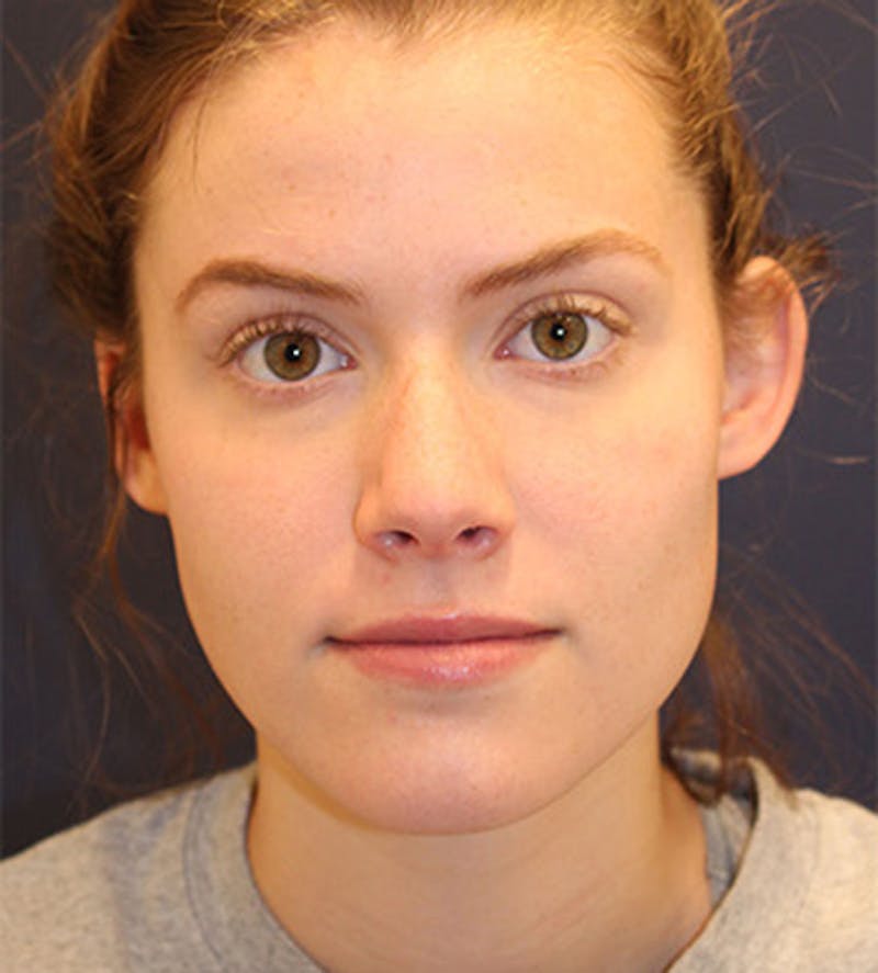 Otoplasty Before & After Gallery - Patient 174146514 - Image 1