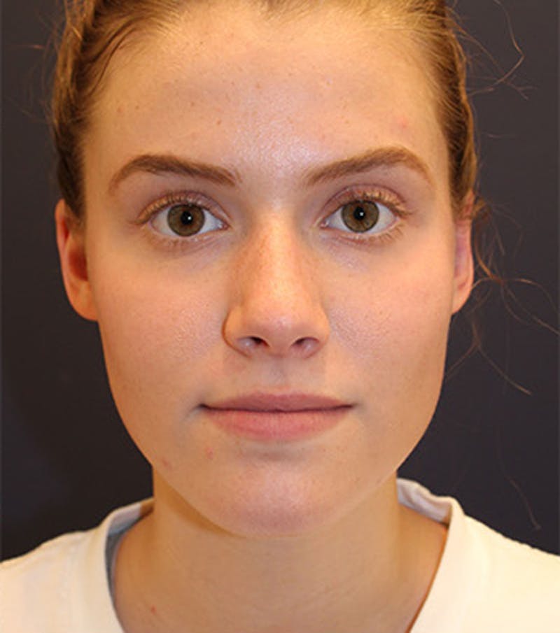 Otoplasty Before & After Gallery - Patient 174146514 - Image 2