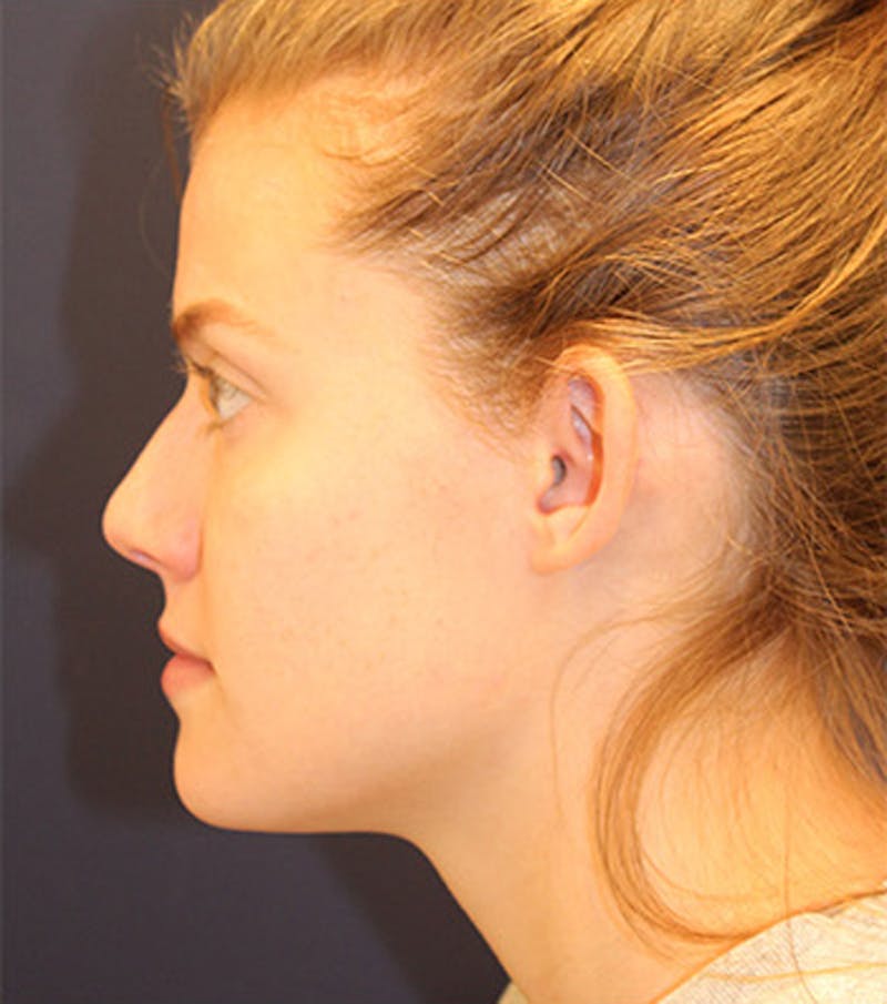 Otoplasty Before & After Gallery - Patient 174146514 - Image 5