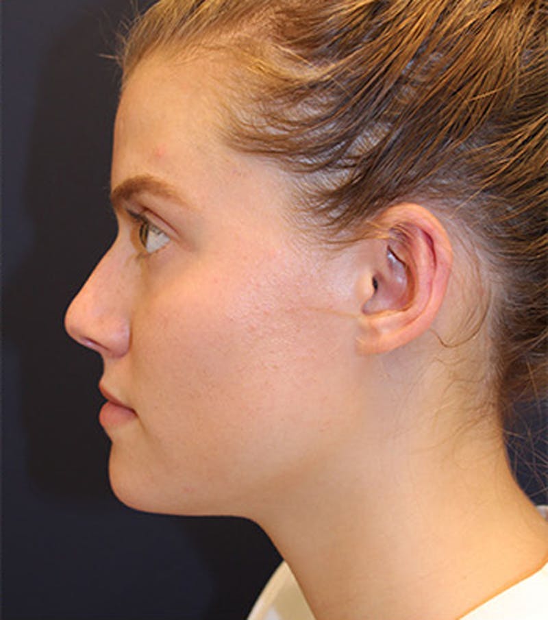 Otoplasty Before & After Gallery - Patient 174146514 - Image 6