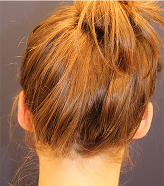 Otoplasty Before & After Gallery - Patient 174146514 - Image 8