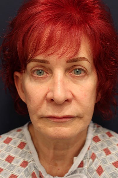 Rhinoplasty Before & After Gallery - Patient 174146512 - Image 1