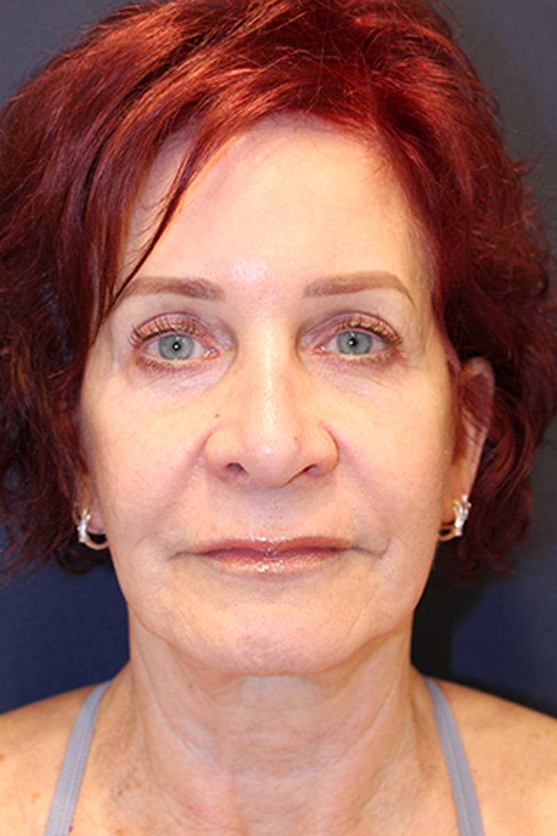 Rhinoplasty Before & After Gallery - Patient 174146512 - Image 2