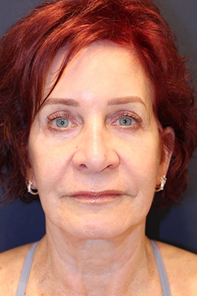 Rhinoplasty Before & After Gallery - Patient 174146512 - Image 2