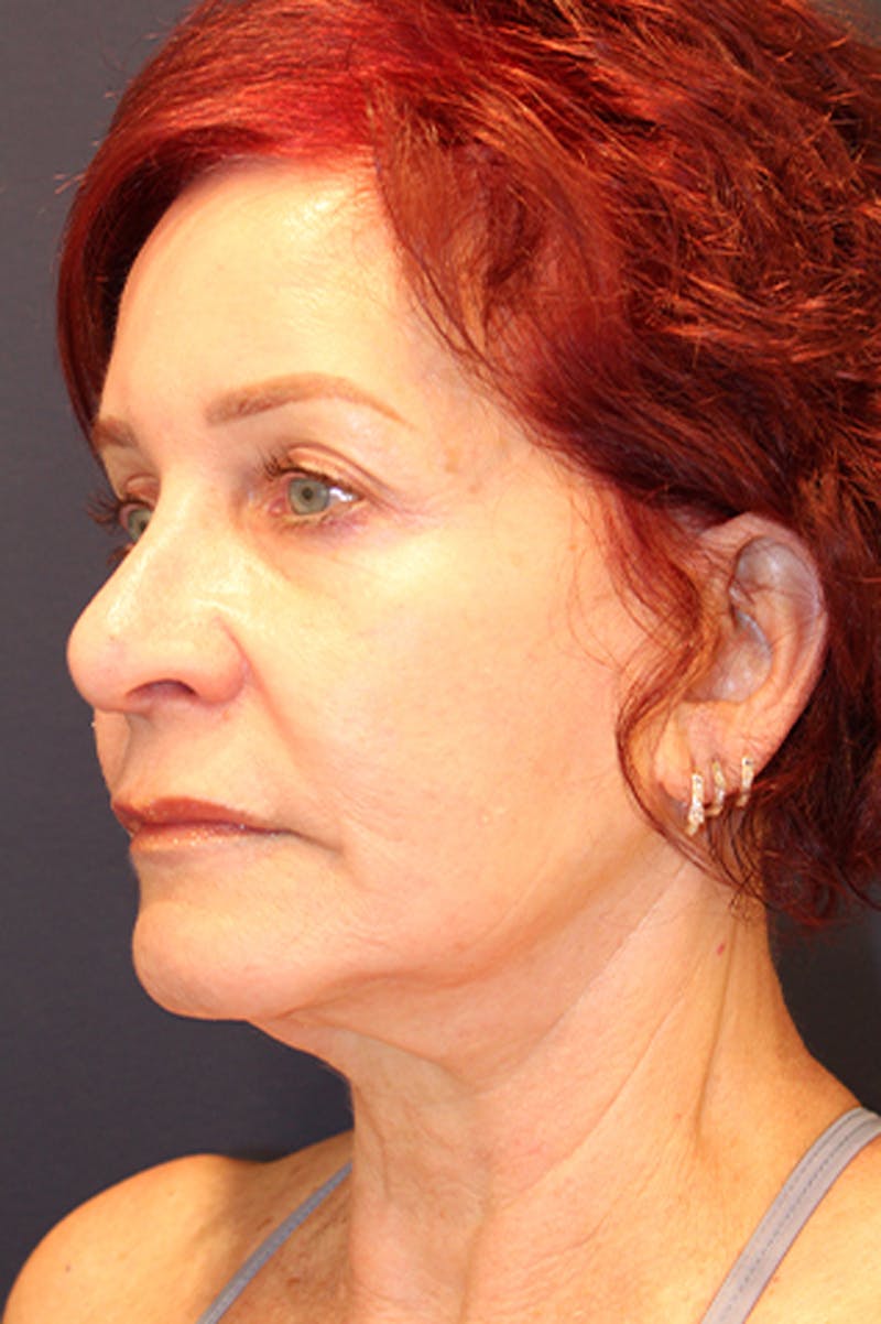 Rhinoplasty Before & After Gallery - Patient 174146512 - Image 4